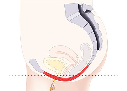 Pelvic-Floor Muscle Repair 5 Pelvic floor muscles Brierley Hill
